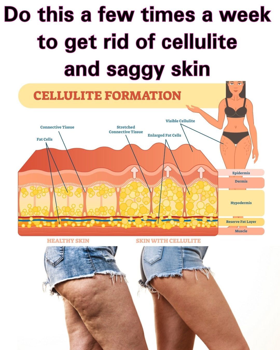 Why do we have cellulite and an easy way to get rid of cellulite too!