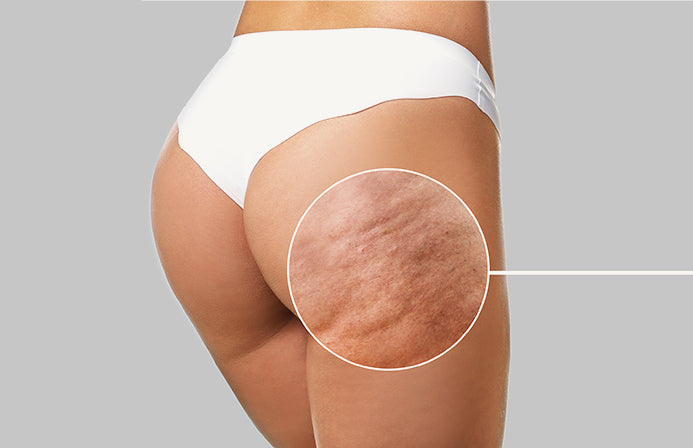 Cellulite Help - Hyaluxe Body