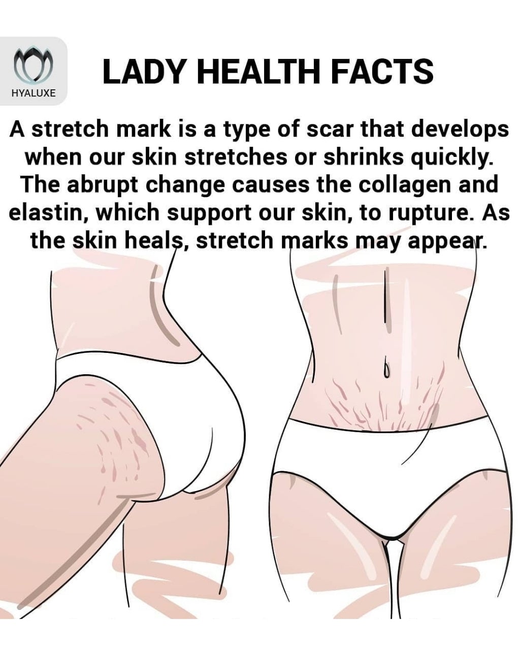 Here is a stretchmark and here are a few ways to make them fade.... - Hyaluxe Body