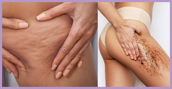Natural remedies for cellulite