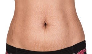 Scars, Stretchmarks and Skin damage: Say goodbye with this little combo - Hyaluxe Body