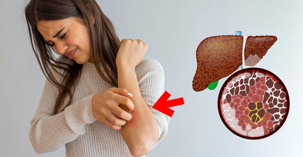 Skin signs of liver damage